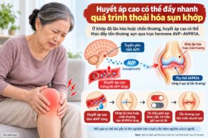Nghiên cứu mới phát hiện huyết áp cao có thể thúc đẩy thoái hóa sụn khớp thông qua cơ chế hormone AVP, mở ra hướng điều trị tiềm năng.